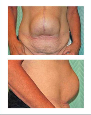 HERNIA INCISIONAL POSTERIOR A CIRUGÍA BARIÁTRICA ABIERTA Downey S. Approach to the abdomen after weight loss. Rubin P, Matarasso A. Aesthetic Surgery After Massive Weight Loss. 1ed. Philadelphia, PA. USA. Saunders, Elsevier. 2007. Cap 5, pág 50.