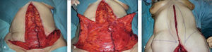 TÉCNICA QUIRÚRGICA PARA ABDOMINOPLASTÍA EN FLEUR DE LIS (A) Marcas de la resección estimada. (B) Primero se realiza la resección transversa, posteriormente la resección vertical. (C) Preservación de los vasos perforantes minimiza los riesgos de necrosis de los colgajos y complicaciones de la herida operatoria. La disección mínima es clave. Toy J, Rubin P. Post-bariatric reconstruction. Neligan P, Warren R. Plastic Surgery. 3ed. USA. Saunders, Elsevier. 2013. Vol II, cap 30, pág. 640.