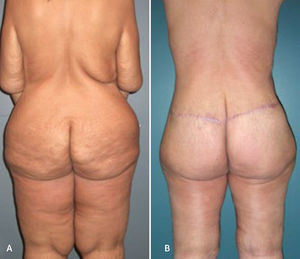 HBODYLIFT INFERIOR CON LIPOSUCCIÓN Mujer de 39 años de edad, baja de peso de 45kg. (A) Inicialmente se realizó un bodylift inferior con una liposucción de muslos de 9 lt, seguida por una segunda intervención de lifting vertical de muslos seis meses después. (B) Rollos mediodorsales fueron corregidos con una resección torácica lateral junto a una mastopexia. Toy J, Rubin P. Post-bariatric reconstruction. Neligan P, Warren R. Plastic Surgery. 3ed. USA. Saunders, Elsevier. 2013. Vol II, cap 30, pág. 648..