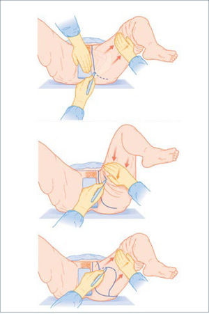 MARCACIÓN PREOPERATORIA DE LIFTING MEDIAL DE MUSLO Hurwitz D. Approach to the medial thigh after weight loss. Rubin P, Matarasso A. Aesthetic Surgery After Massive Weight Loss. 1ed. Philadelphia, PA. USA. Saunders, Elsevier. 2007. Cap 8, pág 120.