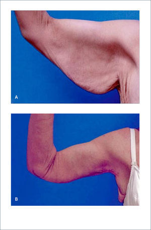 BRAQUIOPLASTIA a) Paciente con baja de peso de 79kg. b) Dos años posbraquioplastia Strauch B, Greenspun D. Approach to the arm after weight loss. Rubin P, Matarasso A. Aesthetic Surgery After Massive Weight Loss. 1ed. Philadelphia, PA. USA. Saunders, Elsevier. 2007. Cap 9, pág 135.