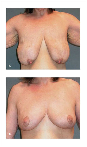 MASTOPEXIA a) Paciente de 46 años, posterior a baja de peso de 73kg. b) Seis meses después de una mastopexia Rubin P, O’Toole J, Agha-Mohammadi S. Approach to the breast after weight loss. Rubin P, Matarasso A. Aesthetic Surgery After Massive Weight Loss. 1ed. Philadelphia, PA. USA. Saunders, Elsevier. 2007. Cap 4, pág 44.