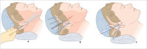 PLASTÍA CARA Y CUELLO a) La liposucción como complemento en facelift. b) Tracción del colgajo facial en facelift. c) El exceso de piel facial es marcado para ser resecado y cerrado sin tensión. Pitanguy I, Radwanski H, Matarasso A. Approach to the face and neck after weight loss. Rubin P, Matarasso A. Aesthetic Surgery After Massive Weight Loss. 1ed. Philadelphia, PA. USA. Saunders, Elsevier. 2007. Cap 3, pág 23.
