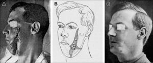 SEGMENTOS DE GRASA PUESTOS EN UNA HERIDA, RESULTADOS FINALES. Gillies H. Plastic surgery of the face. London: Frowde, Hodder, Stoughton; 1920.