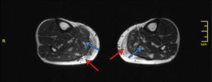 RESONANCIA MAGNÉTICA DE LIPOINYECCIÓN DE PANTORRILLAS A LOS 6 MESES Se aprecia la grasa injertada en plano muscular y subcutáneo. (De: Hoppmann R, Meruane M, Gonzalez D, Wisnia P, Hasbun A, Villalobos B. Calf lipo-reshaping. J Plast Reconstr Aesthet Surg. 2013;66(7):956-61).
