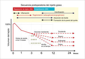 SECUENCIA POSTOPERATORIA DEL INJERTO GRASO La adipogénesis finaliza al 3° mes y los adipocitos muertos son reabsorbidos durante los siguientes 9 meses. Las gotas lipídicas son absorbidas por macrófagos en forma lenta, si las gotas son de más de 8mm se formarán quistes. El volumen final del injerto depende del éxito de reemplazo de los adipocitos muertos. En presencia de grandes gotas oleosas residuales en tejido se atrofiará entre los 3 y 12 meses, evidenciando un resultado pobre. (Modificado de: Yoshimura K, Eto H, Kato H, et al. In vivo manipulation of stem cells for adipose tissue repair/reconstruction. Regen Med 2011;6 (6 Suppl):38).