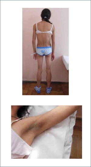 PACIENTE DE 20 AÑOS CON DIABETES LIPOATRÓFICA. Fotografías autorizadas para su publicación.