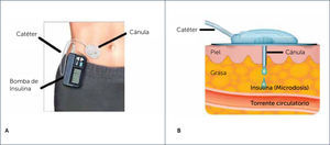 BOMBA DE INSULINA Y SET DE INFUSIÿN (A), POSICIÿN DE LA CÿNULA EN EL TEJIDO SUBCUTÿNEO (B) 2A) Modificado de https://www.nlm.nih.gov/medlineplus/spanish/ency/esp_imagepages/18028.htm 2B) Modificado de Guía Información básica sobre el tratamiento con bomba de insulina. Medtronic.