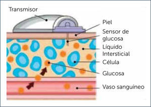 UBICACIÿN DEL SENSOR DEL CGM EN EL TEJIDO SUBCUTÿNEO Modificado de Primeros pasos para el monitoreo continuo de glucosa. Medtronic.