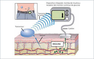 TERAPIA INTEGRADA (SAPT, SENSOR AUGMENTED PUMP THERAPY): BOMBA DE INSULINA Y CGM-RT Modificado de Tumminia A. et al. Patient Preference and Adherence 2015:9 1263⿿127035.