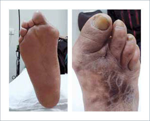 PIE NEUROPÁTICO, DEFORMIDADES DEL PIE