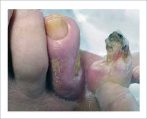 ENFERMEDAD ARTERIAL OCLUSIVA DISTAL. ISQUEMIA AGUDA