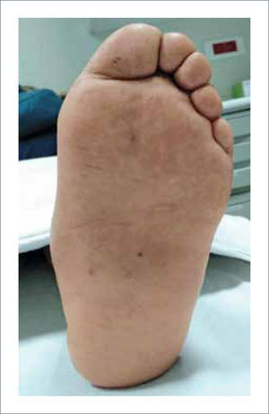 NEUROARTROPATÍA DE CHARCOT