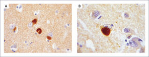 DCL: CORTE HISTOLÿGICO DE CORTEZA Se muestran las neuronas conteniendo Cuerpos de Lewy inmunoreactivos para alfa sinucleína (A) y para anti-ubiquitina (B).(Foto: tomada de referencia bibliográfica 1).