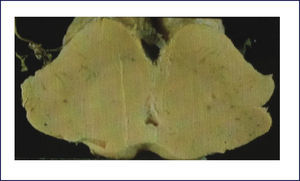 CORTE TRANSVERSAL DE MESENCÿFALO FIJADO EN FORMALINA Ilustra depigmentación severa de la sustancia nigra en enfermedad de Parkinson. (Foto: colección personal).