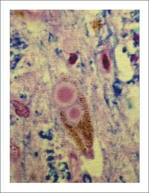 CORTE HISTOLÿGICO DE SUSTANCIA NIGRA TEÿIDO CON H&E Se ilustran inclusiones neuronales citoplasmáticas eosinófilas redondeadas bien delimitadas, correspondientes a Cuerpos de Lewy. (Foto: colección personal).