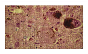 CORTE HISTOLÿGICO DE SUSTANCIA NIGRA TEÿIDO CON H&E Se ilustra neurona conteniendo ONF globoso, con restos de neuromelanina en la periferia. (Foto: colección personal).