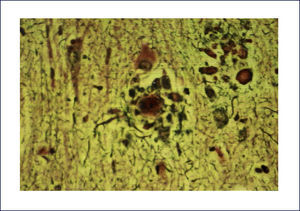 TINCIÿN DE PLATA DE PLACA NEURÿTICA Se destaca el núcleo central denso (beta-amiloide) rodeado por una corona de neuritas distróficas. (Foto: colección personal).