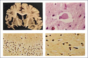 PANEL DE FOTOS ILUSTRANDO LA NEUROPATOLOGÿA DE LA ENFERMEDAD DE PICK Superiores: Izquierda: corte transversal de cerebro que muestra la severa atrofia fronto temporal asimétrica y dilatación ventricular. Derecha: Cuerpo de Pick teñido con hematoxilina eosina, al interior de una neurona. Inferiores: Cuerpos de Pick en neuronas del giro dentado del hipocampo (panel izquierdo), y corteza cerebral (panel derecho) se tiñen marcadamente con las tinciones de plata. (Foto: colección personal).