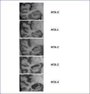 ESCALA DE ATROFIA DEL LÓBULO TEMPORAL MEDIAL (MTA) DESCRITA POR SCHELTENS Es útil para evaluar el grado de atrofia cortical específicamente en la región mesial del lóbulo temporal. Scheltens (Scheltens et al., 1992).