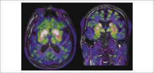 PET DE FLUORODOPA QUE MUESTRA UN PATRÓN DE DENERVACIÓN ESTRIATAL CARACTERÍSTICO DE LA ENFERMEDAD DE PARKINSON Déficit de captación a nivel posterior de ambos putámenes de distribución claramente asimétrica (en este caso de predominio en el estriado izquierdo).