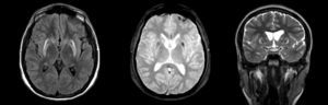 ALTERACIONES DE RESONANCIA MAGNÉTICA CEREBRAL CARACTERÍSTICAS EN UN PACIENTE CON PARKINSONISMO SECUNDARIO A ENFERMEDAD DE WILSON Se observa disminución de volumen del estriado, asociado a aumento de señal en secuencia T2 y FLAIR y artefacto de susceptibilidad magnética en secuencia T2 gradiente.