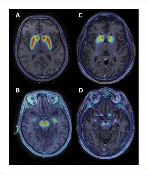 IMÁGENES DE 18F-PR04.MZ PET FUSIONADA CON RESONANCIA MAGNÉTICA CEREBRAL Sujeto control a nivel de estriado (A) y mesencéfalo (B) y en los mismos niveles en un paciente con enfermedad de Parkinson (C y D). Se observa una marcada disminución de la actividad dopaminérgica a nivel estriatal (caudado y putamen) y en mesencéfalo, en el área correspondiente a la sustancia nigra. (Imágenes gentileza Dres. Horacio Amaral y Vasko Kramer).