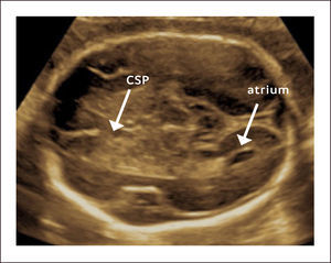 CORTE TRANSVENTRICULAR CSP: cavum septum pellucidum.