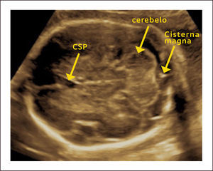 CORTE TRANSCEREBELAR CSP: cavum septum pellucidum.