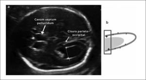 MEDICIÓN CORRECTA DEL ATRIUM El corte para realizar la medición del atrium es el transventricular y la colocación de los calipers es de borde interno a borde interno. Modificado de Figueras F et al. Curso de actualización en medicina maternofetal 2012.