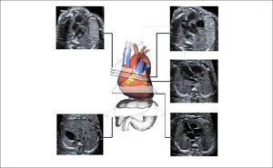 PLANOS DE SECCIÓN TRANSVERSALES ASCENDENTES. DESDE CEFÁLICO A CAUDAL, ABDOMEN, CUATRO CÁMARAS, TRACTO DE SALIDA DE AORTA, TRACTO DE SALIDA DE PULMONAR, TRES VASOS TRÁQUEA.