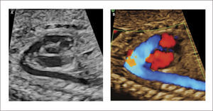 ARCO DUCTAL A imagen modo B, B imagen Doppler color.