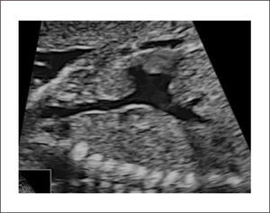 IMAGEN DE EJE LARGO DE VENA CAVA.