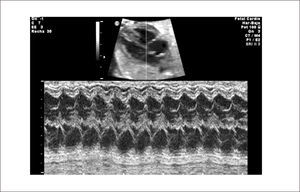 ECOCARDIOGRAFÍA MODO-M PARA ESTABLECER RITMO NORMAL Cada contracción ventricular está precedida de una contracción auricular.