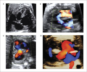 COMUNICACIÓN INTERVENTRICULAR (CIV) A) CIV perimembranosa, b) Muscular Doppler color, c) muscular eje corto, d) muscular 3D color.