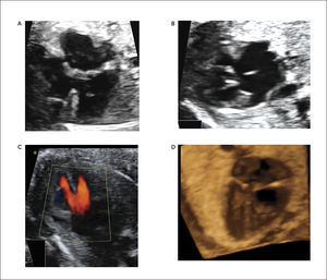 CANAL ATRIOVENTRICULAR A) Imagen modo B cuatro cámaras. B) canal AV incompleto, C) Flujo de entrada por válvula única. D) Canal AV en reconstrucción 3D.