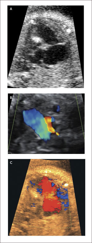 SÍNDROME DE HIPOPLASIA VENTRICULAR IZQUIERDA A) Modo B, B) Dopper color. C) Plano de tres vasos.