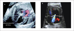 INSUFICIENCIA VALVULAR A) Mitral, B) Tricúspidea.