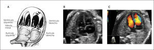 VISIÓN DE 4 CÁMARAS DEL CORAZÓN FETAL A Esquema, B imagen modo B, C imagen Doppler color. AD= aurícula derecha; VD= ventrículo derecho; AI= aurícula izquierda; VI= ventrículo izquierdo.