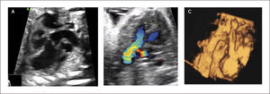 TRONCO ARTERIOSO A) Modo B, B) Doppler color, C) Reconstrucción 3D.