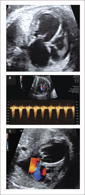 ESTENOSIS AÓRTICA A) Cuatro cámaras modo B, B) Válvula aórtica Doppler color, C) Flujo inverso en foramen oval.