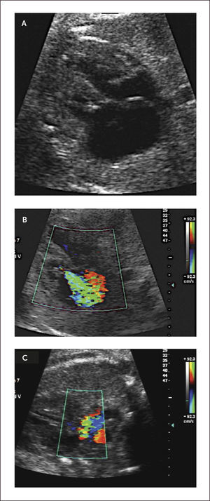 ESTENOSIS PULMONAR A) Cuatro cámaras modo B, B) Insuficiencia tricúspidea Doppler color, C) Estenosis pulmonar Doppler color.