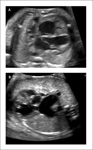 AGENESIA VELOS PULMONARES A) Cuatro cámaras, B) Ausencia de válvula pulmonar, dilatación de arteria pulmonar y sus ramas.