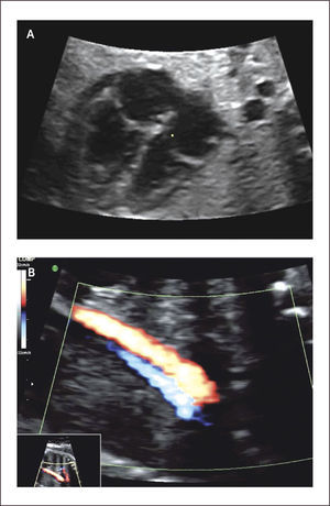 Sindrome Cardioesplénico A) Cuatro cámaras, B) Retorno vía ácigos.