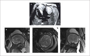 TUMORES CARDÍACOS A) Rabdomioma. B) Esclerosis Tuberosa en paciente con rabdomioma.