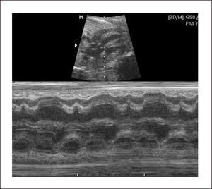 EXTRASÍSTOLE VENTRICULAR. AISLADA Y RITMO BIGEMINADO.
