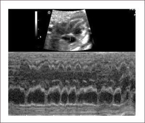 TAQUICARDIA SUPRAVENTRICULAR Conducción 1: 1.