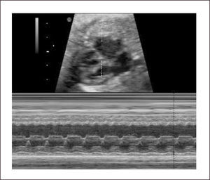 FLUTTER AURICULAR Alta frecuencia con bloqueo 2:1.