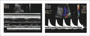 BLOQUEO AV COMPLETO Completa disociación entre contracciones auriculares y ventriculares, a) Modo M aurículo ventricular, b) Doppler color simultáneo de vena y arteria umbilical.
