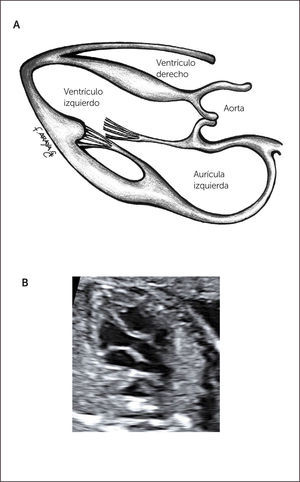 IMAGEN DE EJE LARGO A Esquema, B imagen modo B, AI = aurícula izquierda; VI = ventrículo izquierdo; Ao = aorta.